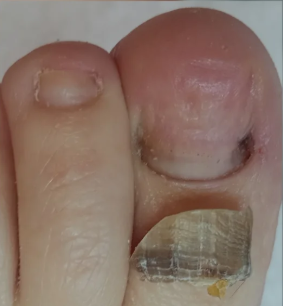 Después del tratamiento de Onicomicosis (hongo)